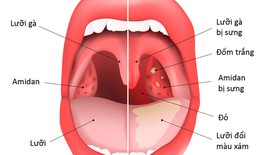 Viêm amidan, chớ để thành mạn tính