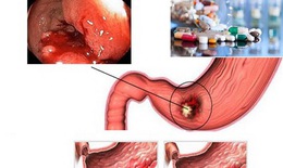 Đề phòng một số thuốc gây xuất huyết tiêu hóa