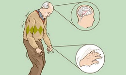 Khắc phục bất lợi khi dùng levodopa trị Parkinson