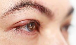 Dị ứng mắt trong m&#249;a h&#232;