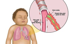 Biến chứng do viêm tiểu phế quản ở trẻ em