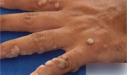 Thuốc nào trị mụn cóc?