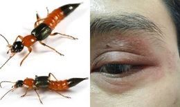 Mùa này: Cảnh giác viêm da tiếp xúc do côn trùng