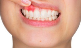 Áp-xe răng: Chữa trị sớm, tránh ảnh hưởng lan rộng