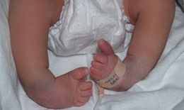 Cứng đa khớp bẩm sinh ở trẻ sơ sinh: Bệnh hiếm gặp, có thể phát hiện sớm