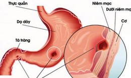 Xuất huyết tiêu hóa, ngừa thế nào?