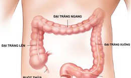 Người bệnh viêm đại tràng mạn tính tránh ăn gì?