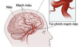 Cần phát hiện sớm phình mạch não