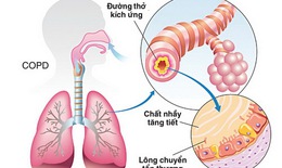 Phải tuân thủ dùng thuốc trị COPD
