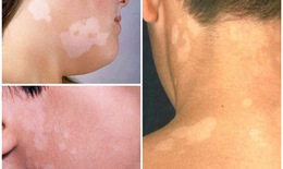 Kiểm soát nấm lang ben mùa ẩm