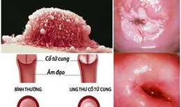 Lây nhiễm HPV và nguy cơ ung thư cổ tử cung