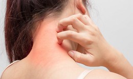 Nguyên nhân gây dị ứng thực phẩm