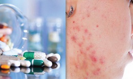 Thuốc hạ mỡ máu có thể gây viêm xơ cứng và tràn dịch màng bồ đào