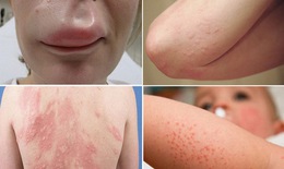 Dị ứng thời tiết: những điều cần biết