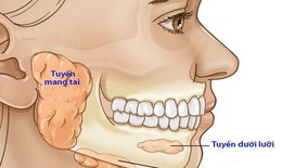Nhận biết viêm nhiễm dễ gặp vùng hàm mặt