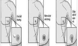 Đàn ông cũng phải cảnh giác với ung thư vú
