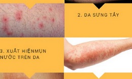 Điểm mặt bệnh da thường gặp vào mùa hè