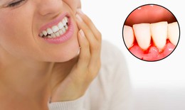 Chảy máu chân răng: Nguyên nhân và cách khắc phục