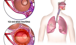 Dưỡng âm thanh phế thang - phương thuốc quý hồi phục tốt sau viêm phổi