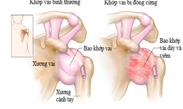 Ðề phòng viêm quanh khớp vai