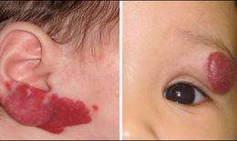 U máu: đừng vội nghĩ đến xạ trị
