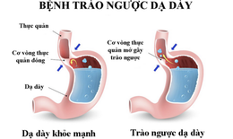 Thuốc trị trào ngược dạ dày - thực quản: Đặc biệt thận trọng khi dùng