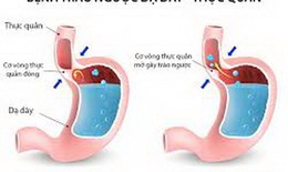 Bài thuốc trị trào ngược dạ dày - thực quản