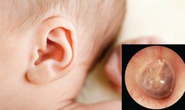Viêm tai giữa cấp có nguy hiểm?