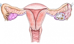 Nhận biết ung thư nội mạc tử cung