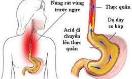 Trào ngược dạ dày - thực quản gây ho nhiều, vì sao?