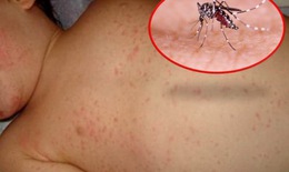 Một số bài thuốc hỗ trợ trị sốt xuất huyết