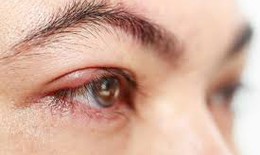 Khô mắt có dẫn đến viêm kết mạc?