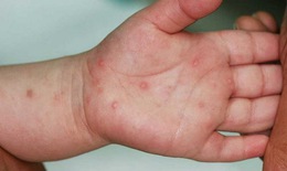 Bôi thuốc gì khi trẻ bị tay - chân - miệng?