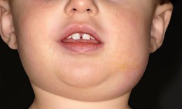 Chăm sóc trẻ mắc quai bị
