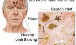 Phòng bệnh Alzheimer ở người lớn tuổi