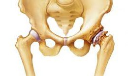 Ai dễ bị hoại tử chỏm xương đùi?
