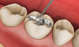 Các đối tượng không nên dùng chất trám răng chứa thủy ngân