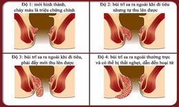 Ngừa bệnh trĩ ở người cao tuổi