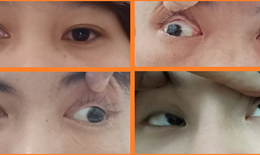 Phòng ngừa và điều trị lác mắt