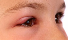 Chấn thương mắt do làm nông có thể gây mù