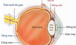Viêm mống mắt có thể dẫn đến mù lòa