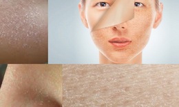 Cảnh giác với biến chứng do da khô