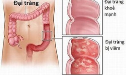 Phân biệt hội chứng ruột kích thích và viêm ruột