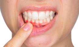 Viêm lợi có gây rụng răng?