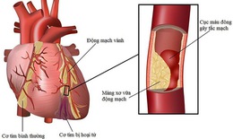 Dấu hiệu nhận biết bệnh tim mạch