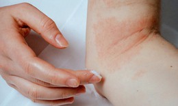 Cách giảm ngứa khi bị eczema