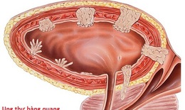 Điểm mặt các yếu tố nguy cơ gây ung thư bàng quang
