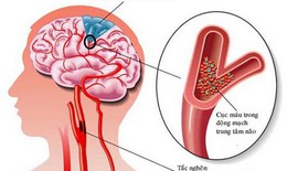 Đột quỵ vì tự dừng thuốc chống đông máu