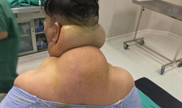 Cổ, vai gáy bị biến dạng khủng khiếp vì uống quá nhiều rượu, bia
