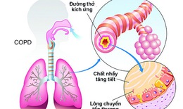 Ứng phó với cơn cấp bệnh phổi tắc nghẽn mạn tính